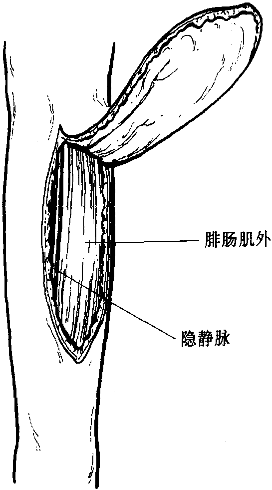 12 小腿后側皮瓣